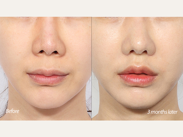 lip lift and revision rhinoplasty