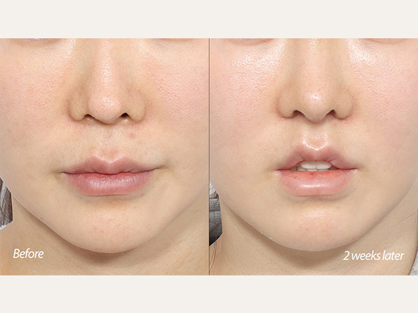 lip lift and revisional rhinoplasty