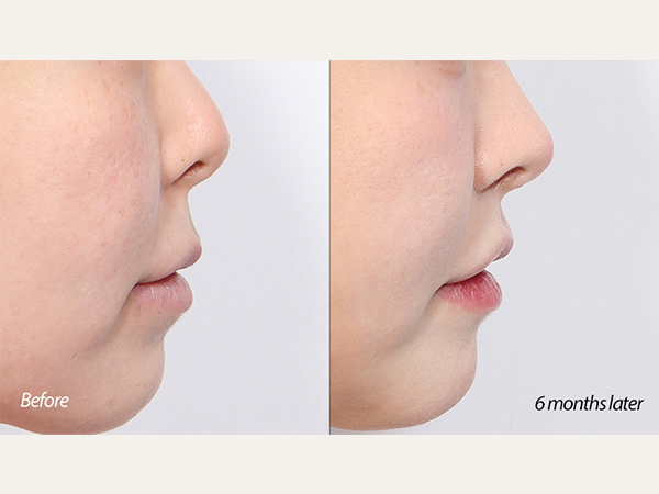 lip lift and revision rhinoplasty