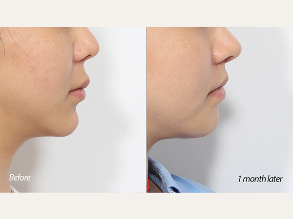 facial contouring - chin revision surgery