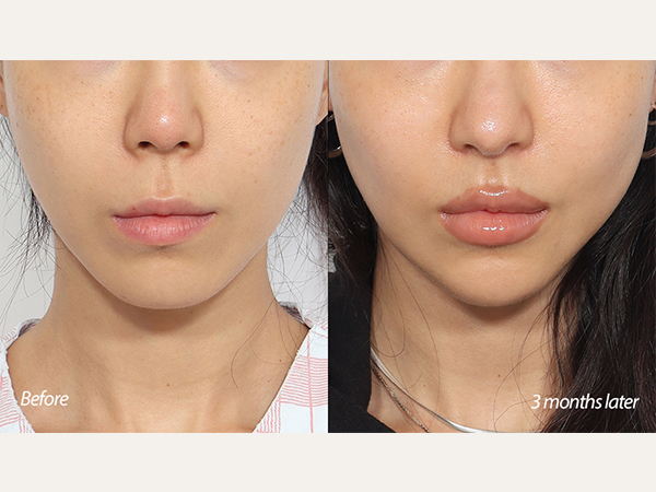 facial contouring - mini V-line surgery (jaws and chin reduction)