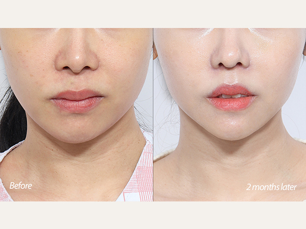 facial contouring - mini V-line surgery (jaws and chin reduction)