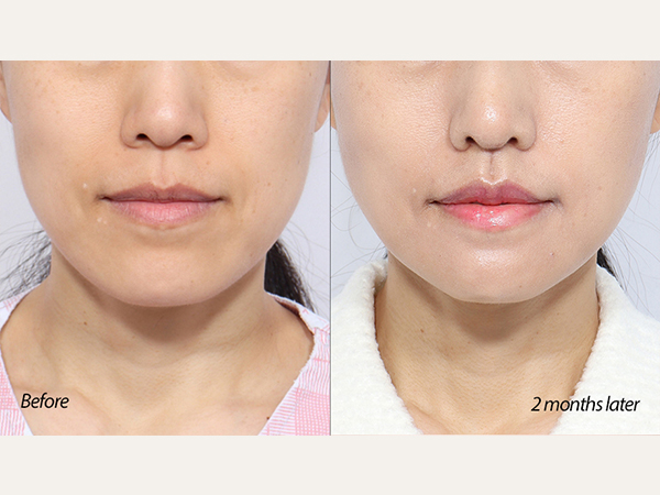 facial contouring - V-line surgery (jaws and chin reduction)