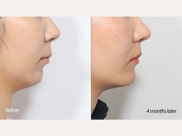 facial contouring - chin advancement surgery