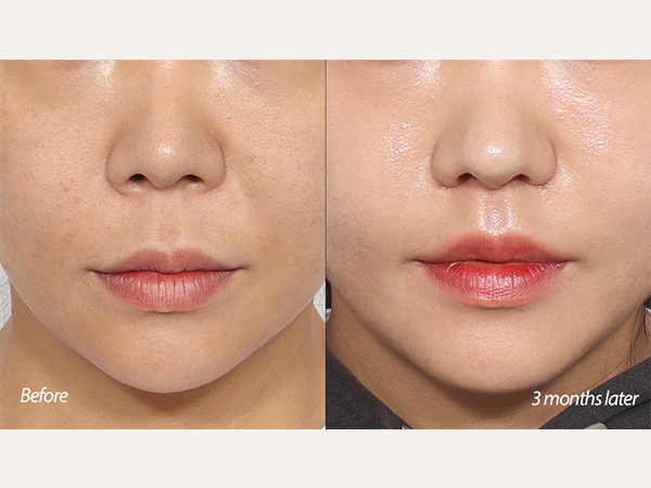 lip lift and tip revision
