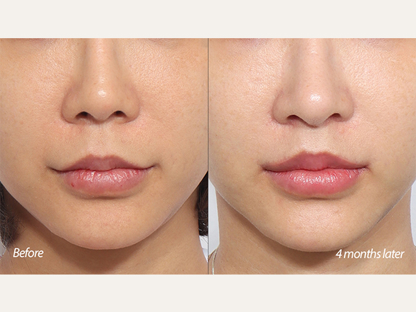 corner lip lift lip lift revision rhinoplasty revision