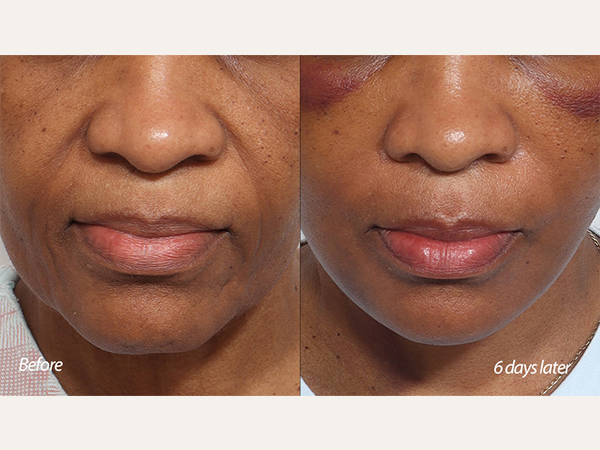 facelift, face lift, 안면거상