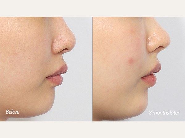 인중축소 코수술 코재수술 동안수술 lip lift philtrum reduction rhinoplasty nose job revisional rhinoplasty