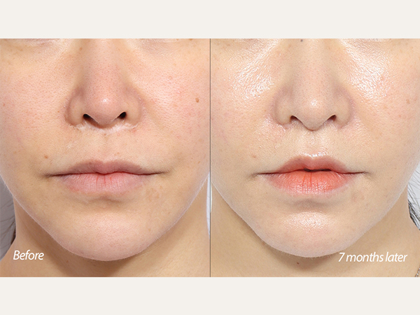 revisional lip lift revision lip lift philtrum reduction