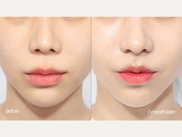 lip lift and revisional tip plasty