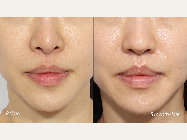 revisional lip lift and revisional rhinoplasty