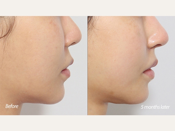 Lip lift, Revisional tip plasty and genioplasty