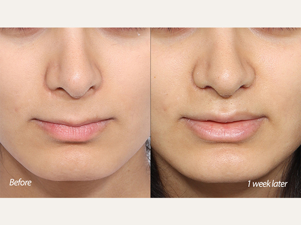 lip lift