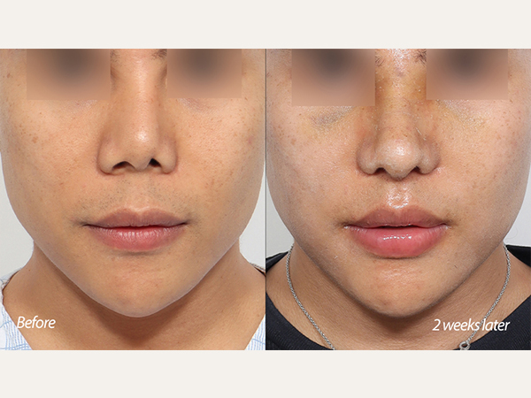 lip lift and revisional rhinoplasty