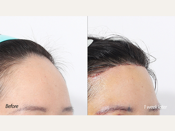 forehead reduction 이마축소, lip lift 인중축소