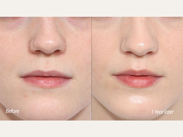 lip lift, upper lip lifting, philtrum reduction, scarless lip lift, 인중축소